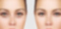 Before and After Surgery